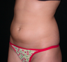 Liposuction