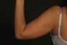Liposuction
