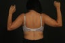 Liposuction