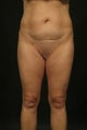 Liposuction