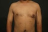 Gynecomastia