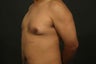 Gynecomastia