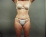 Liposuction