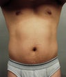 Liposuction