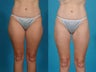 Liposuction