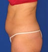 Liposuction, SmartLipo™