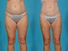Liposuction