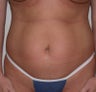 Liposuction