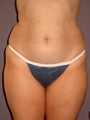 Liposuction