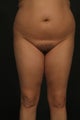 Liposuction