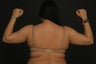 Liposuction