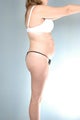 liposuction