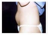 Liposuction