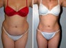 Liposuction