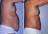 Liposuction