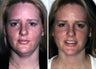 Liposuction of the neck