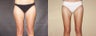 Liposuction