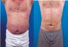 Male Liposuction