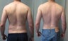 Liposuction