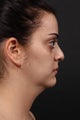 Liposuction of the neck