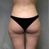 Liposuction