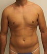 Liposuction