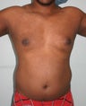 male liposuction