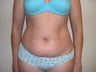 Liposuction 