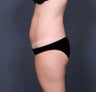 Liposuction