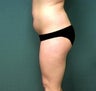 Liposuction