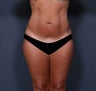 Liposuction