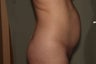 Liposuction