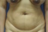 Liposuction