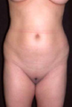 Liposuction