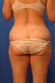 Liposuction