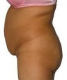 Liposuction