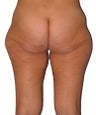 Liposuction