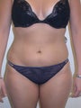 Liposuction