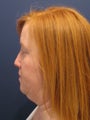 Neck liposuction
