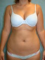 Liposuction of abdomen back and thighs