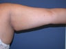 Liposuction of arms