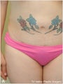 Liposuction