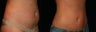 Liposuction