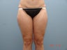 Liposuction