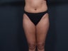 Liposuction