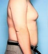 Liposuction