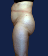 liposuction