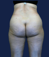 liposuction