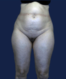 liposuction