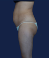 liposuction
